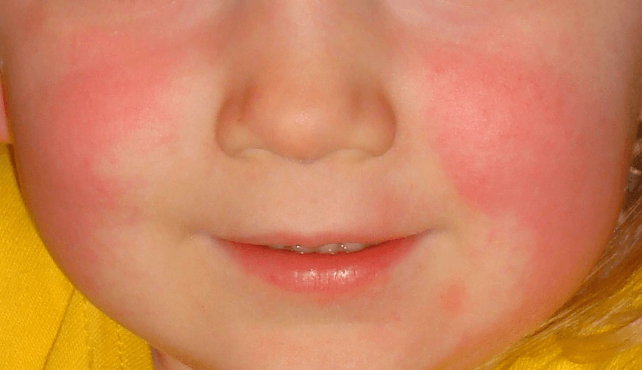 Síntomas de fiebre escarlata en niños