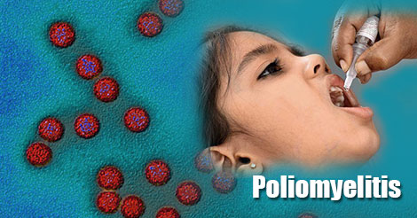 Síntomas de poliomielitis en niños