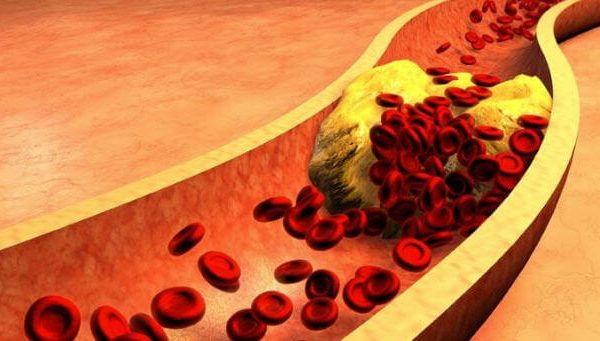 ¿Cuáles son las Diferencias entre el Colesterol Bueno y el Malo?