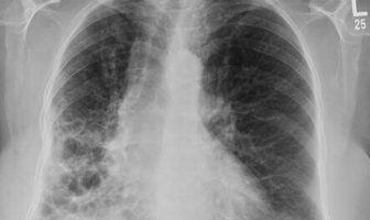 ¿Cuáles son las causas y los síntomas de la bronquiectasia?