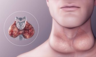 El Bocio Causa Síntomas y Tipos - ¿Cuáles son los tipos de enfermedad del bocio?