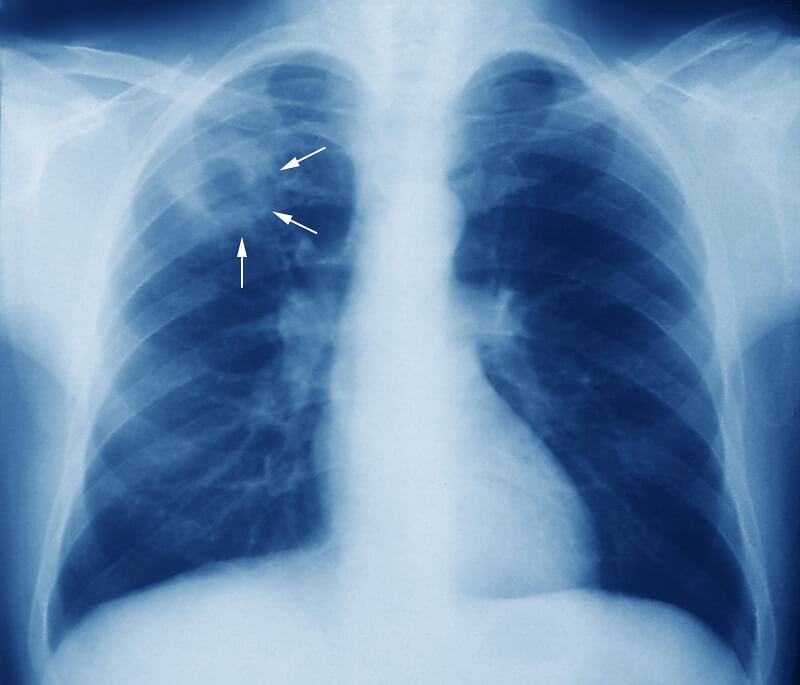 Causas y síntomas de la tuberculosis: complicaciones de la tuberculosis