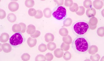 ¿Qué es la leucemia? Síntomas y complicaciones de la leucemia