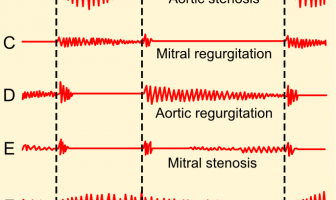 Fonocardiogramas de ruidos cardíacos normales y anormales.