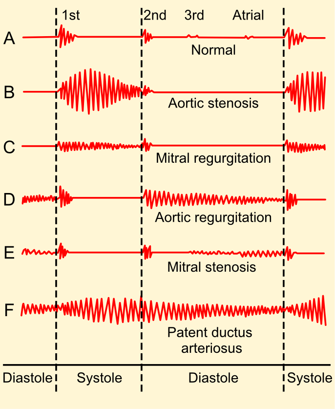 Fonocardiogramas de ruidos cardíacos normales y anormales.