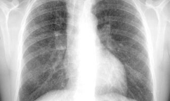 Radiografía de tórax que muestra silicosis sin complicaciones