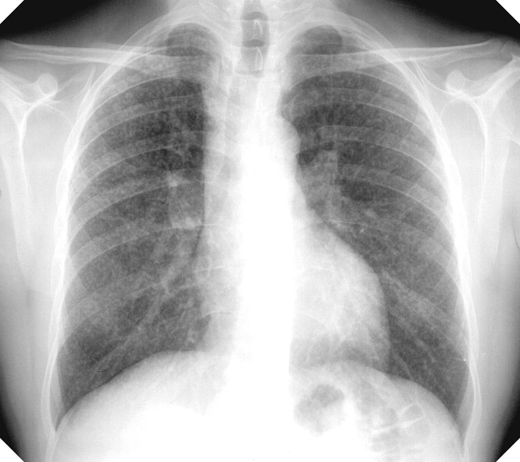 Radiografía de tórax que muestra silicosis sin complicaciones